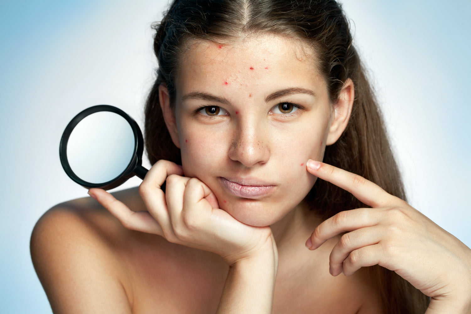 Prevent Acne Breakouts: Avoid Hidden Sources of Bacteria